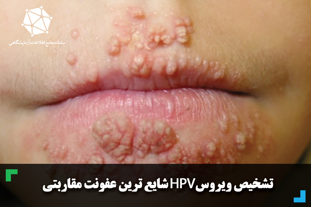 تشخیص ویروس HPV شایع ترین عفونت مقاربتی