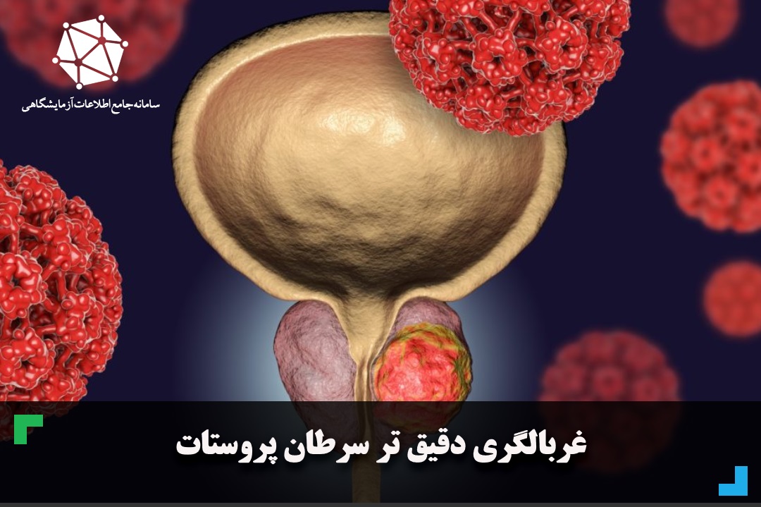 غربالگری دقیق تر سرطان پروستات