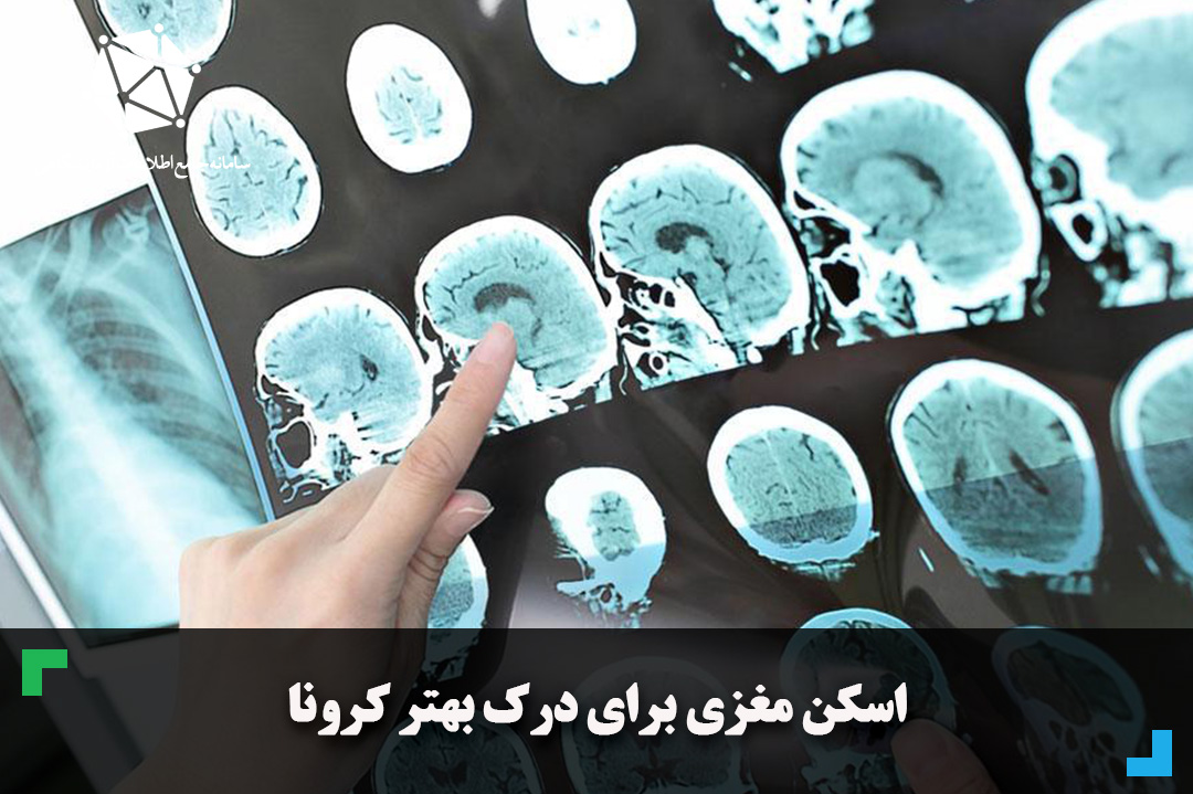 اسکن مغز بیماران MS برای درک بهتر کرونا