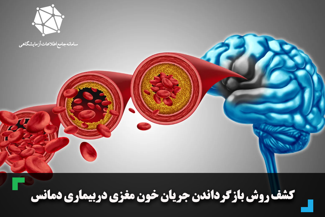 کشف روش بازگرداندن جریان خون مغزی دربیماری دمانس