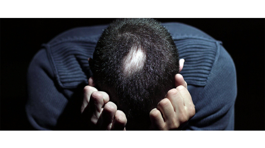 نخستین دارو برای رشد موها در بیماران آلوپسی