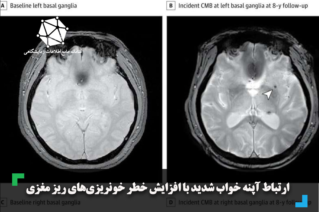 ارتباط آپنه خواب شدید با افزایش خطر خونریزی‌های ریز مغزی