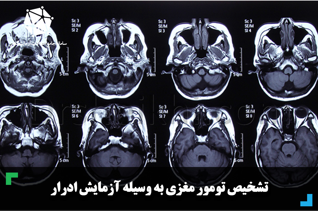 تشخیص تومور مغزی به وسیله آزمایش ادرار